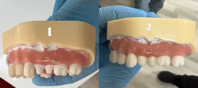 Practicing techniques on dental models